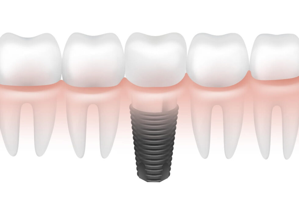 Paso A Paso De La Colocaci N De Un Implante Dental Koresdent