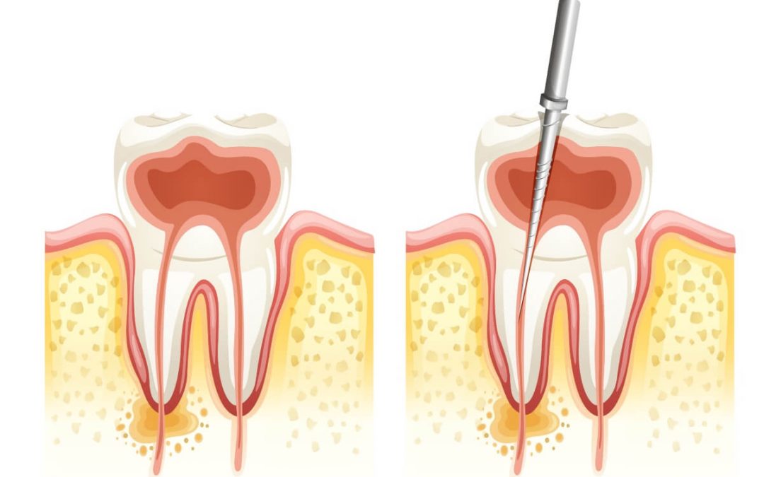¿Qué tipos de endodoncia existen?