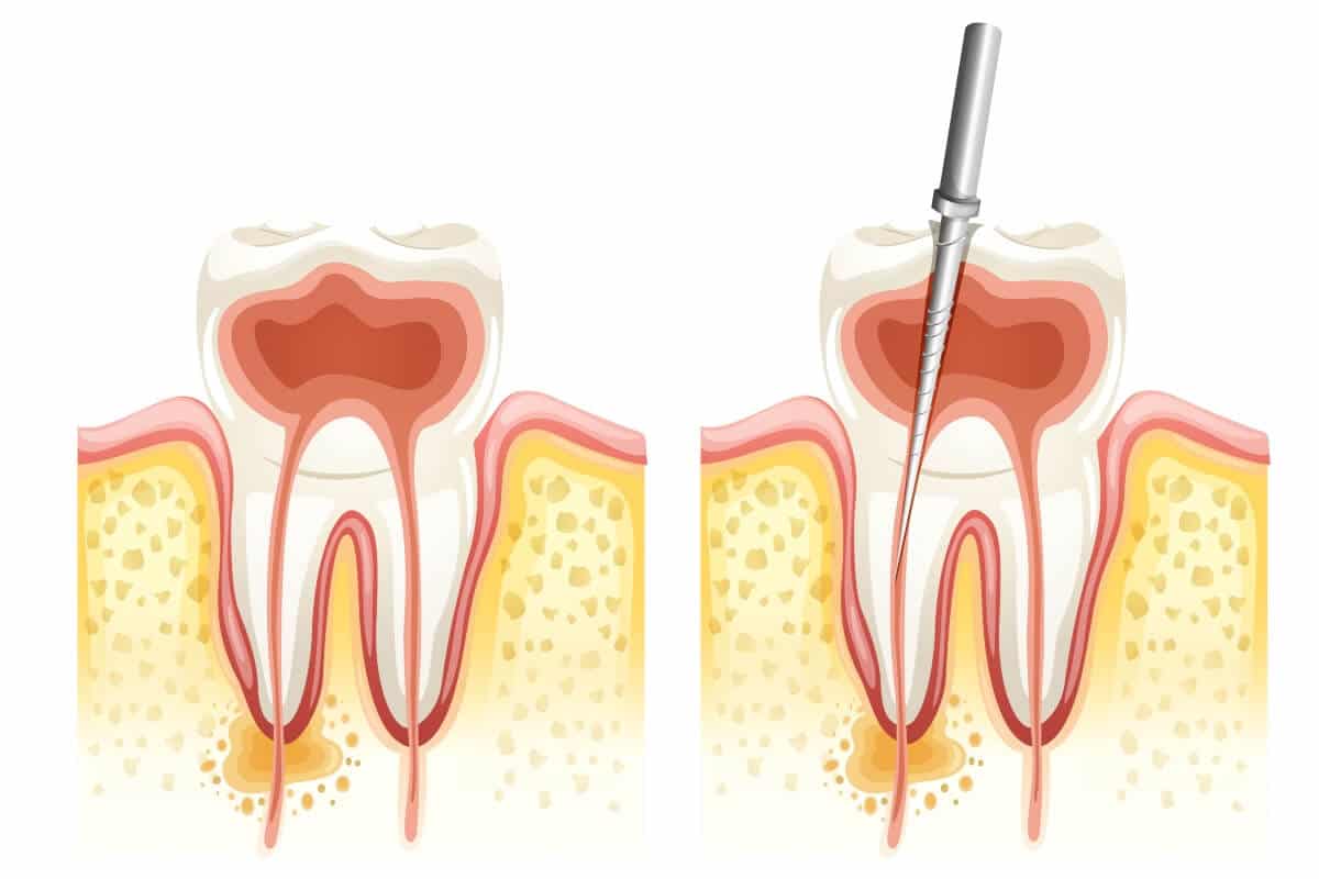¿Qué tipos de endodoncia existen? Clínica Dental Koresdent