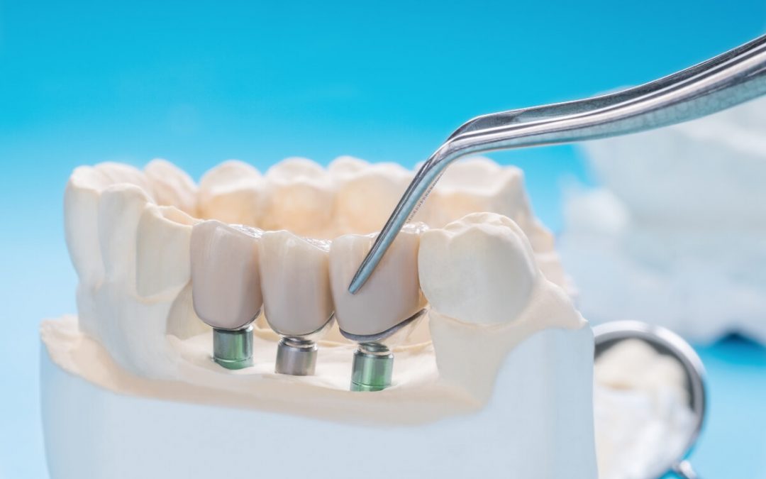 Molestias tras un implante dental