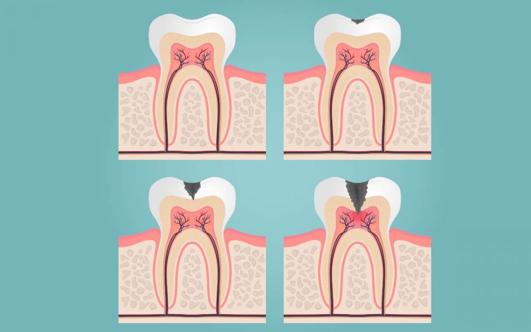 Endodoncia o empaste, ¿qué necesito?
