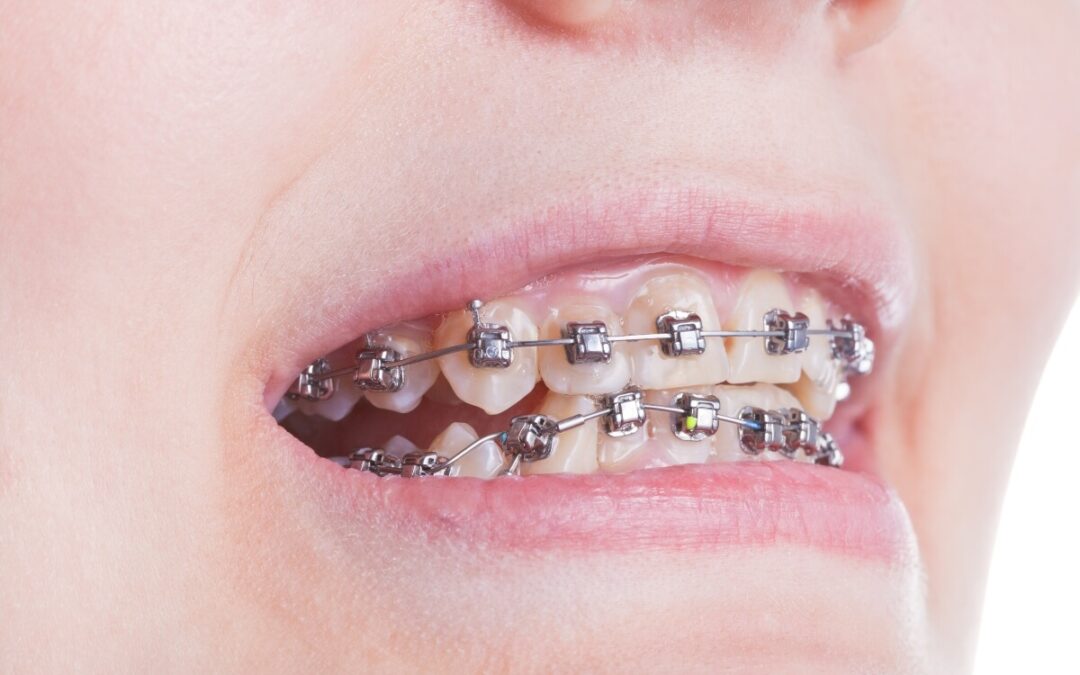 Brackets de baja fricción: una alternativa a la ortodoncia tradicional