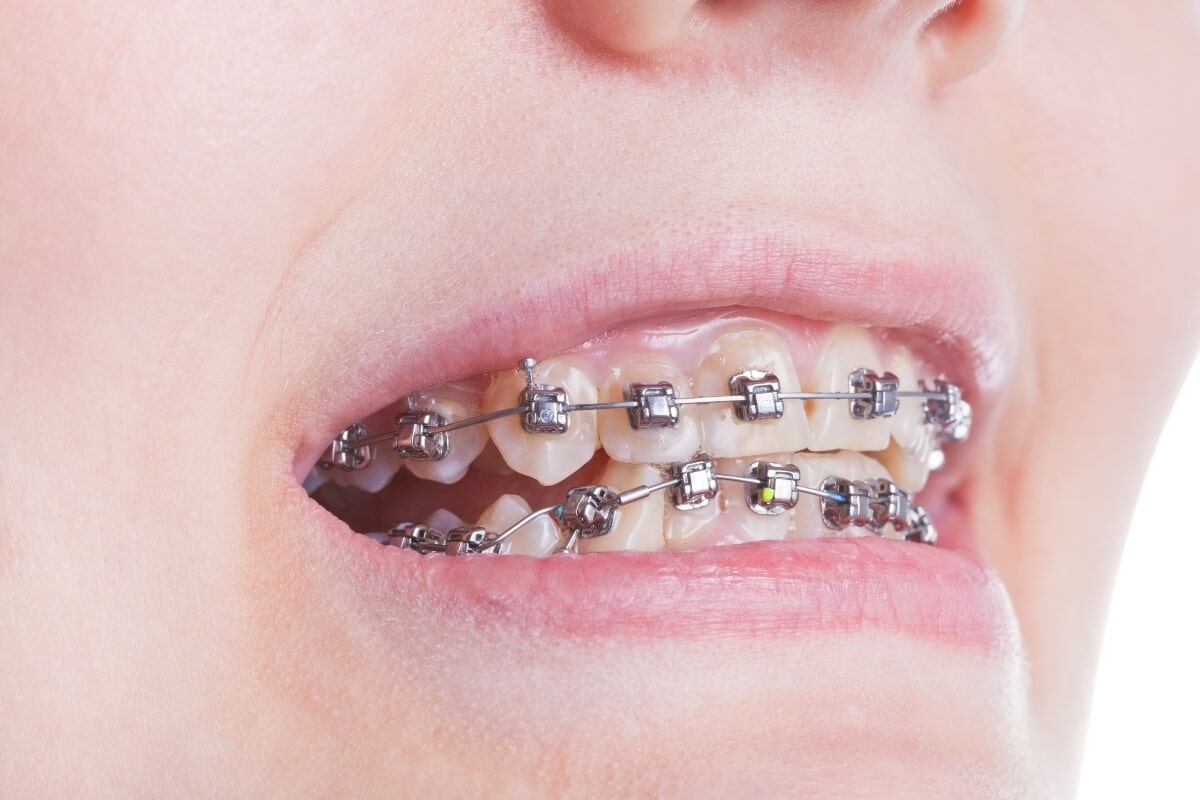 ortodoncia de brackets - clinica dental koresdent sevilla