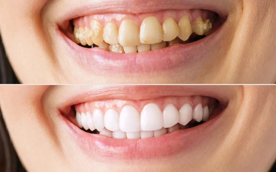 ¿Por qué los dientes se vuelven amarillos?
