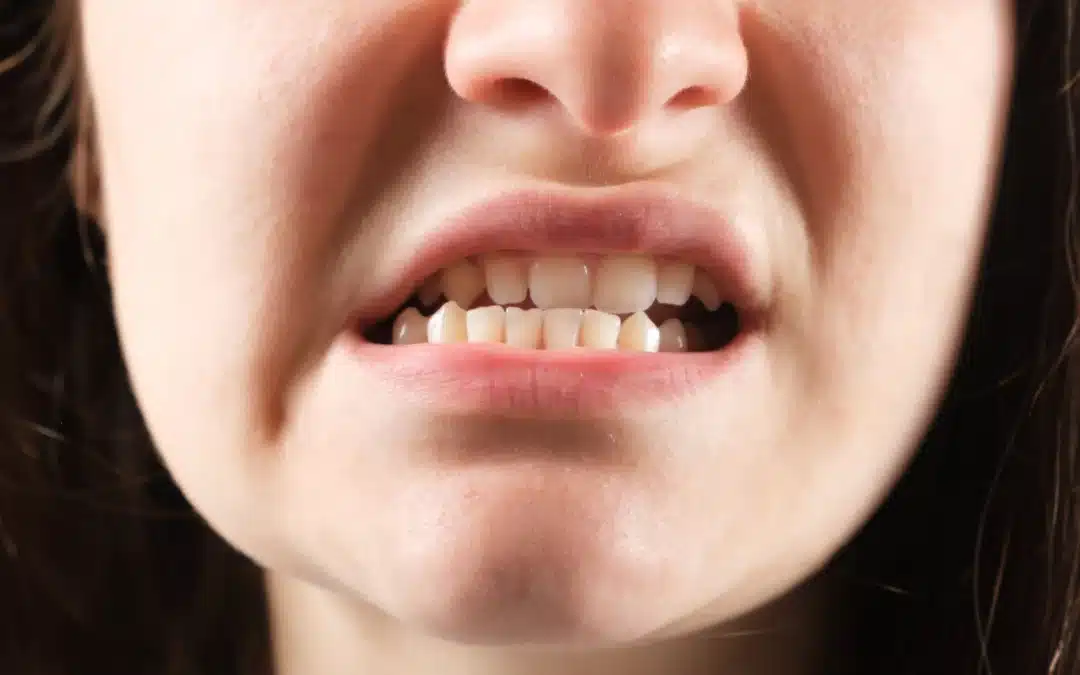 Maloclusión dental: causas, síntomas y opciones de tratamiento
