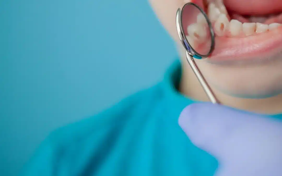 Caries dentales: Definición, causas y tratamientos