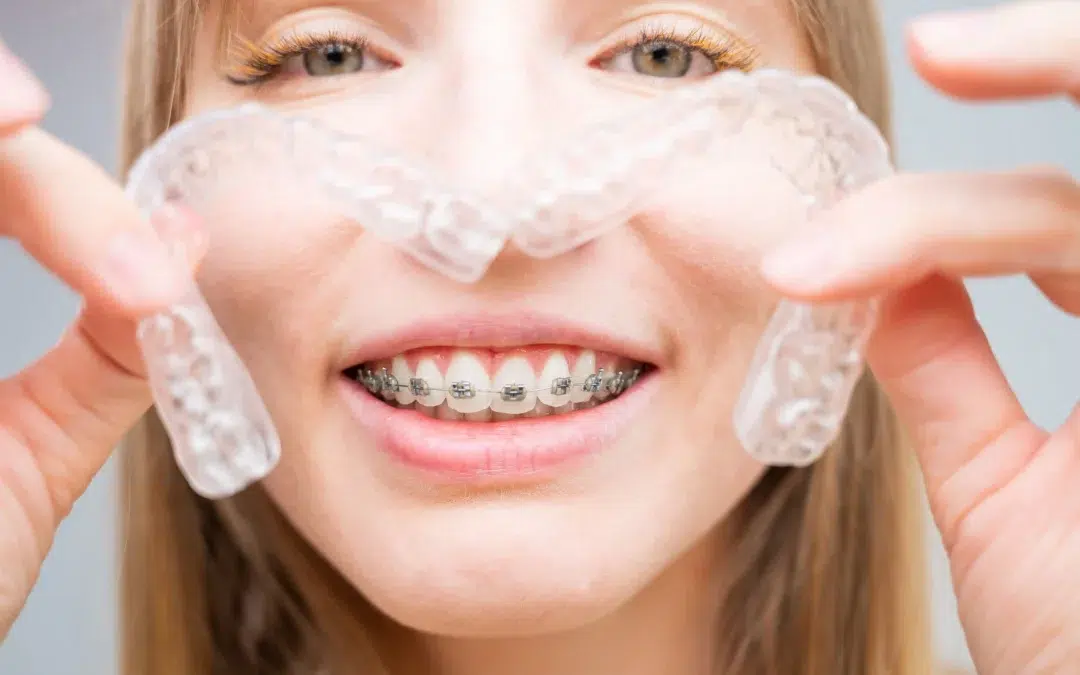 Brackets Vs Ortodoncia Invisible Cuál Es La Opción Adecuada Para Ti