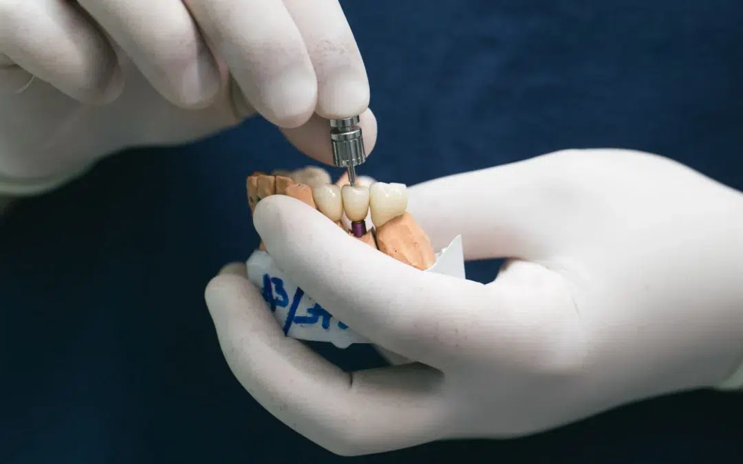 Perimplantitis qué es y cómo prevenirla en tus implantes dentales en sevilla nervion koresdent